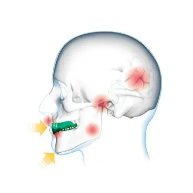 Protège-dents Shock Doctor Gel Max Power Carbon Trans Bleu