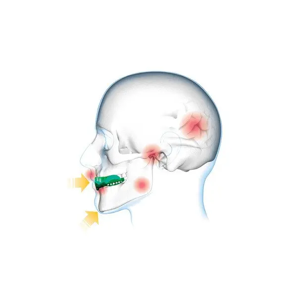 Protège-dents Shock Doctor Gel Max Power Carbon Trans Bleu